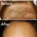Vivace Before and After
