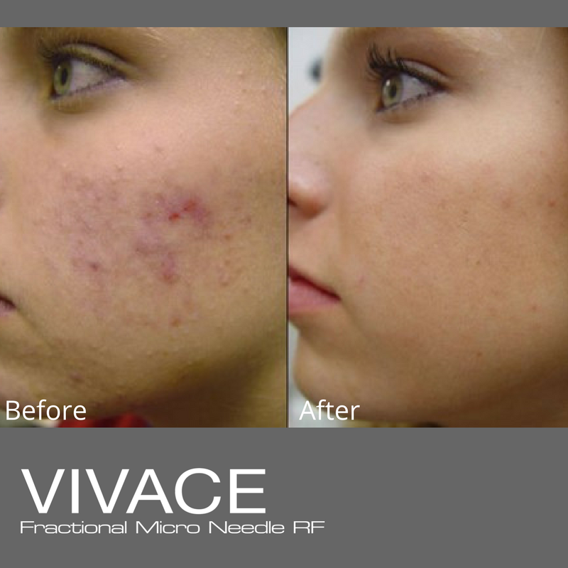 Vivace Before and After