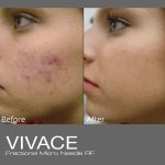 Vivace Before and After