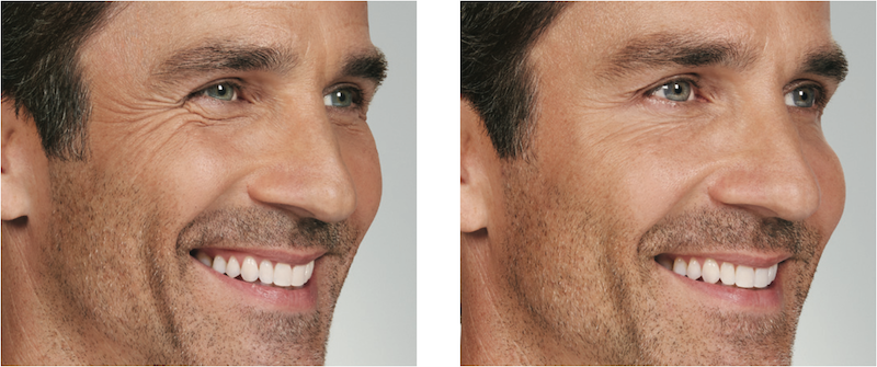 Botox Before and After image
