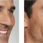 Botox Before and After image