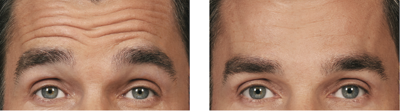 Botox Before and After image