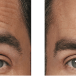 Botox Before and After image