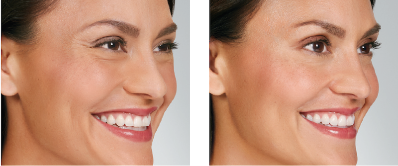 Botox Before and After image