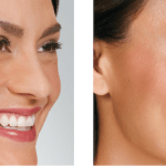 Botox Before and After image
