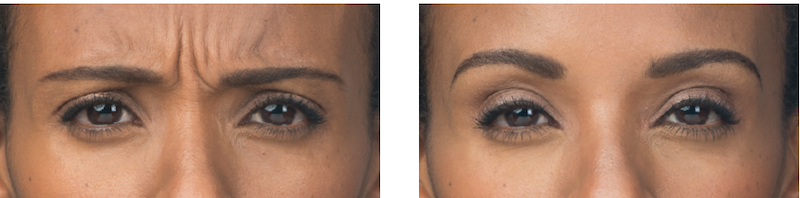 Botox Before and After image