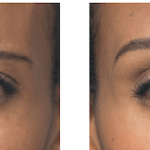 Botox Before and After image