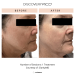 Small image showing before and after Pico on woman's face.