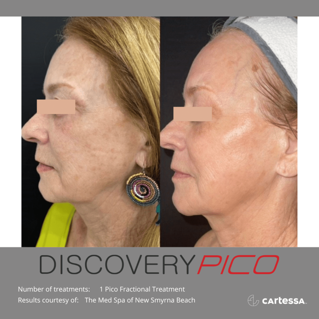 Large before and after of Pico treatment on woman's face.