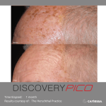 Large up close image of before and after Pico treatment on head.