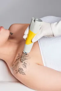 Woman having a tattoo removed