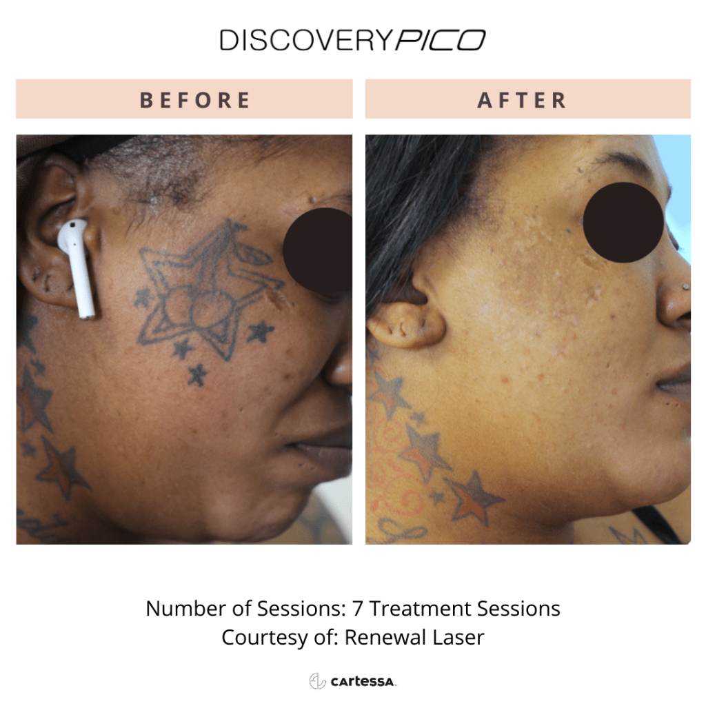 Before and after Pico treatment of face tattoo on woman.