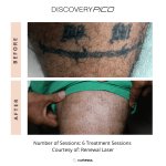Small image of before and after Pico tattoo removal procedure.